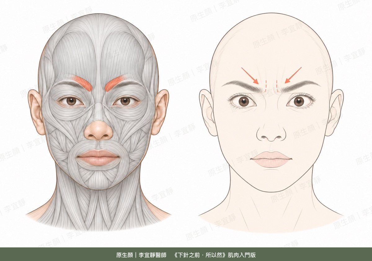 皺眉肌的位置與收縮時的表情
