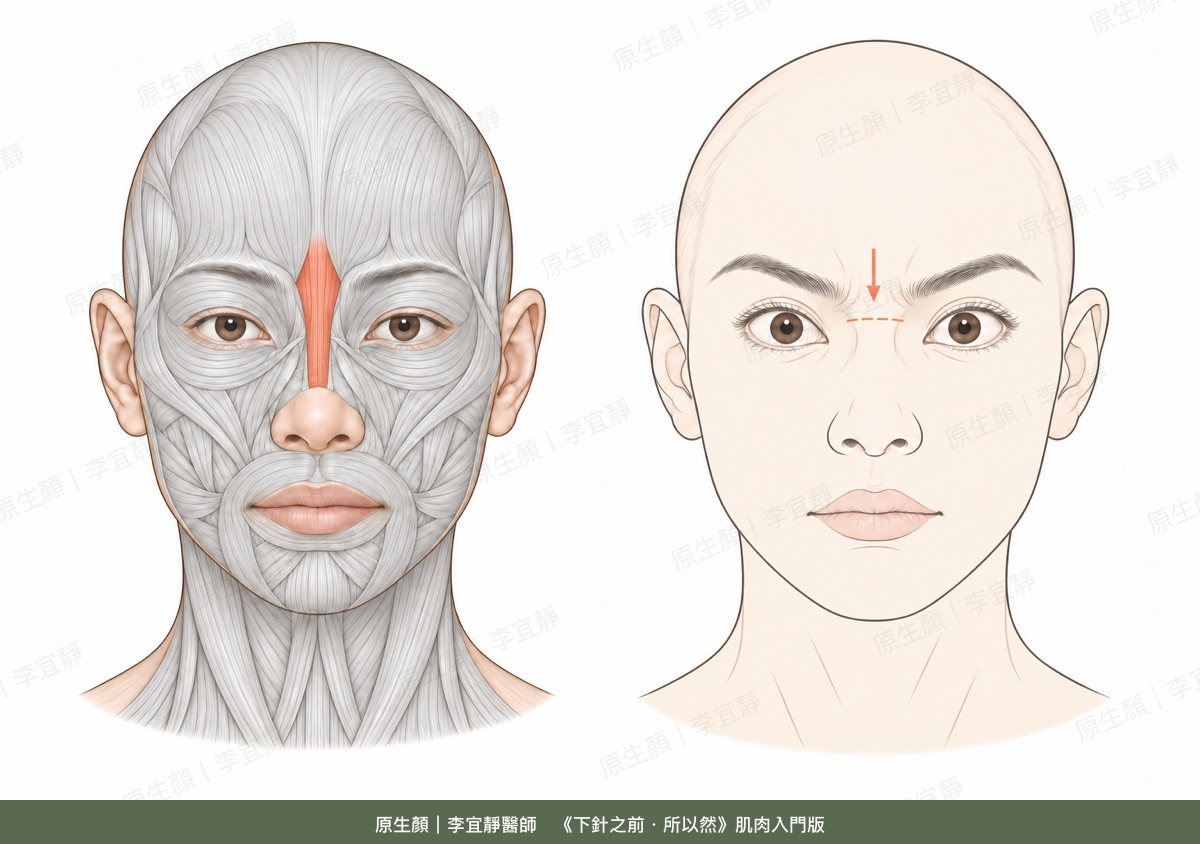 鼻根肌的位置與收縮時的表情